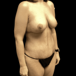 Mommy Makeover Before & After Patient #733