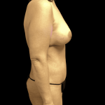 Mommy Makeover Before & After Patient #733