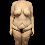 Mommy Makeover Before & After Patient #738