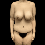Mommy Makeover Before & After Patient #738