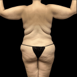Mommy Makeover Before & After Patient #738
