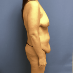 Mommy Makeover Before & After Patient #748