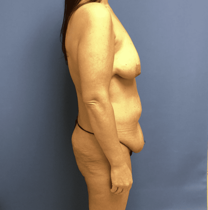 Mommy Makeover Before & After Patient #748