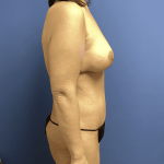 Mommy Makeover Before & After Patient #748