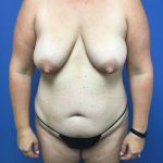 Mommy Makeover Before & After Patient #753