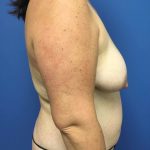 Mommy Makeover Before & After Patient #753