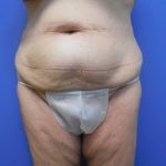 Mommy Makeover Before & After Patient #758