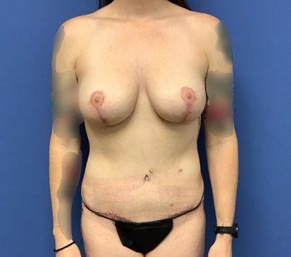 Mommy Makeover Before & After Patient #763