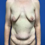 Mommy Makeover Before & After Patient #768