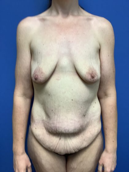 Mommy Makeover Before & After Patient #768