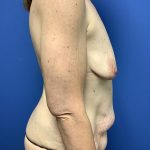 Mommy Makeover Before & After Patient #768