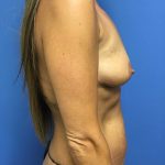 Mommy Makeover Before & After Patient #773