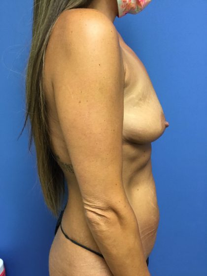 Mommy Makeover Before & After Patient #773