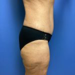 Mommy Makeover Before & After Patient #778