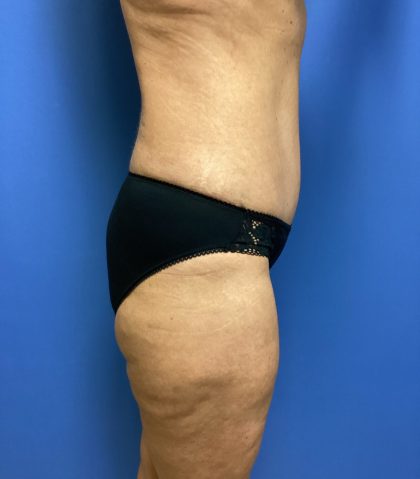 Mommy Makeover Before & After Patient #778