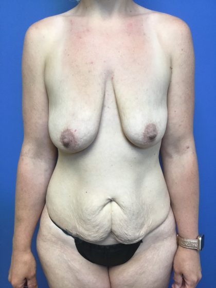 Mommy Makeover Before & After Patient #783