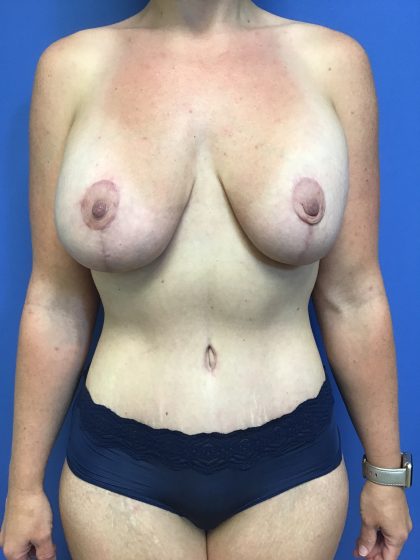 Mommy Makeover Before & After Patient #783