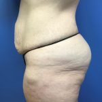 Mommy Makeover Before & After Patient #783