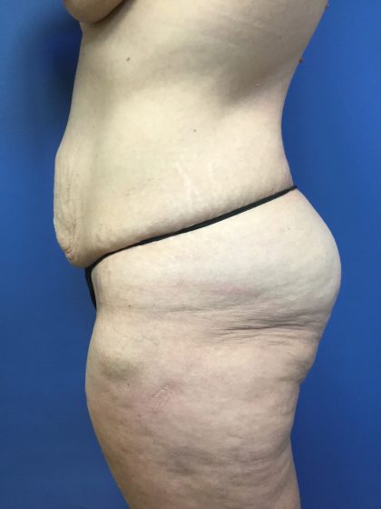 Mommy Makeover Before & After Patient #783