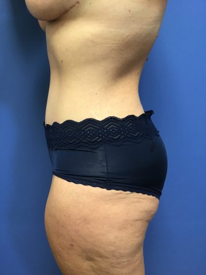 Mommy Makeover Before & After Patient #783