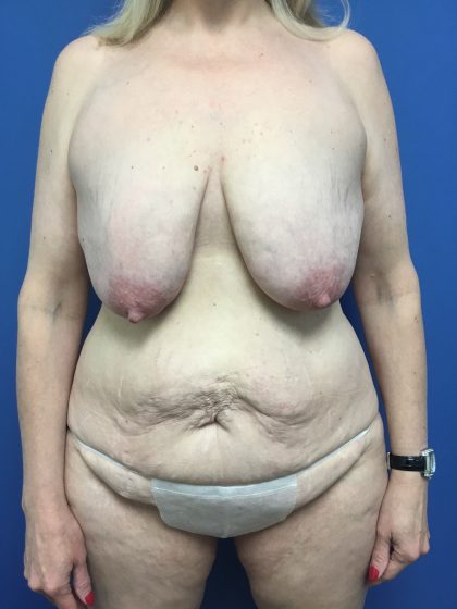 Mommy Makeover Before & After Patient #788