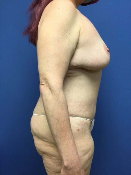 Mommy Makeover Before & After Patient #788