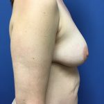 Mommy Makeover Before & After Patient #798