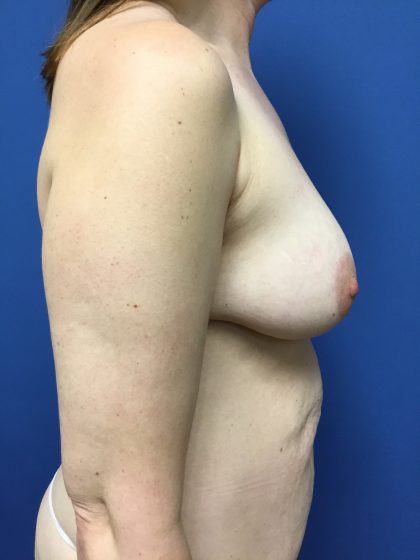 Mommy Makeover Before & After Patient #798