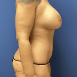 Mommy Makeover Before & After Patient #803