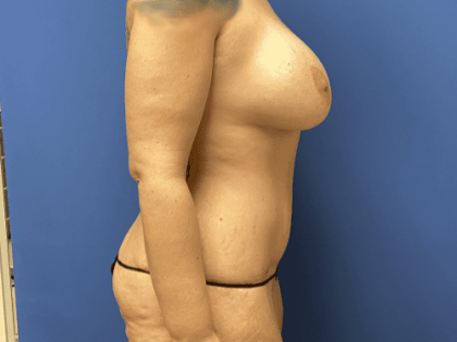 Mommy Makeover Before & After Patient #803