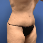 Tummy Tuck Before & After Patient #2522