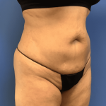 Tummy Tuck Before & After Patient #2522