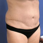 Tummy Tuck Before & After Patient #2532