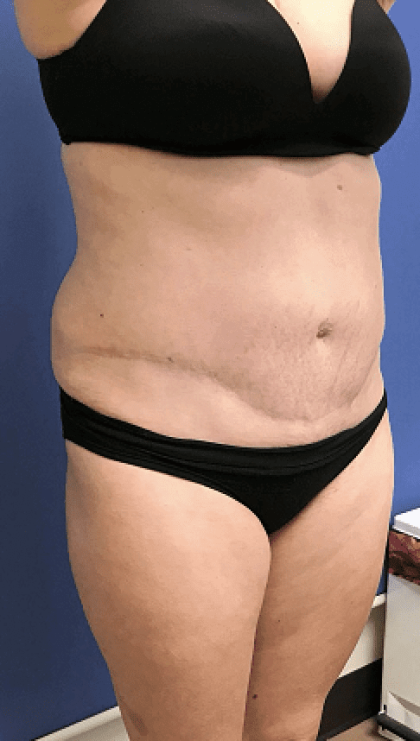 Tummy Tuck Before & After Patient #2532
