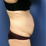 Tummy Tuck Before & After Patient #2532