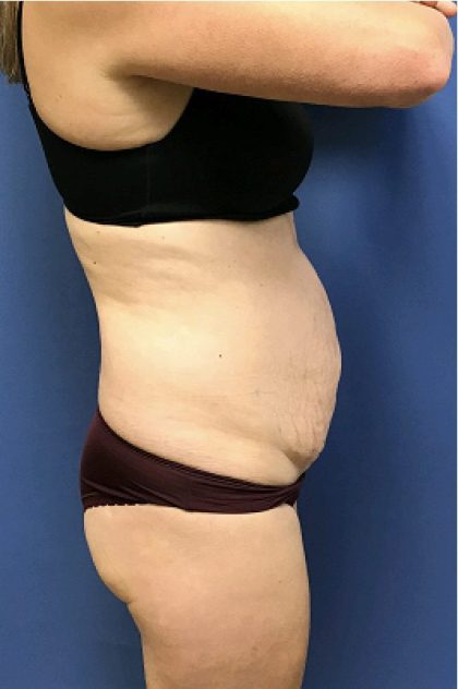 Tummy Tuck Before & After Patient #2532