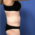Tummy Tuck Before & After Patient #2532