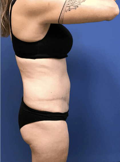Tummy Tuck Before & After Patient #2532