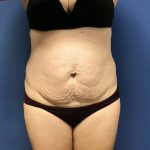 Tummy Tuck Before & After Patient #2532