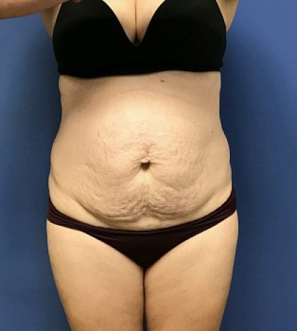 Tummy Tuck Before & After Patient #2532