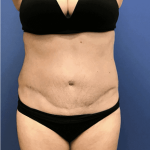 Tummy Tuck Before & After Patient #2532