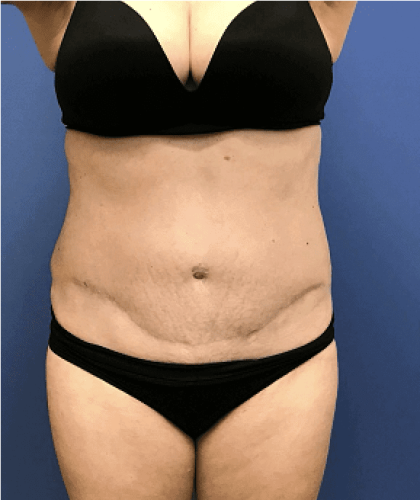 Tummy Tuck Before & After Patient #2532