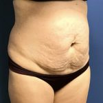 Tummy Tuck Before & After Patient #2532