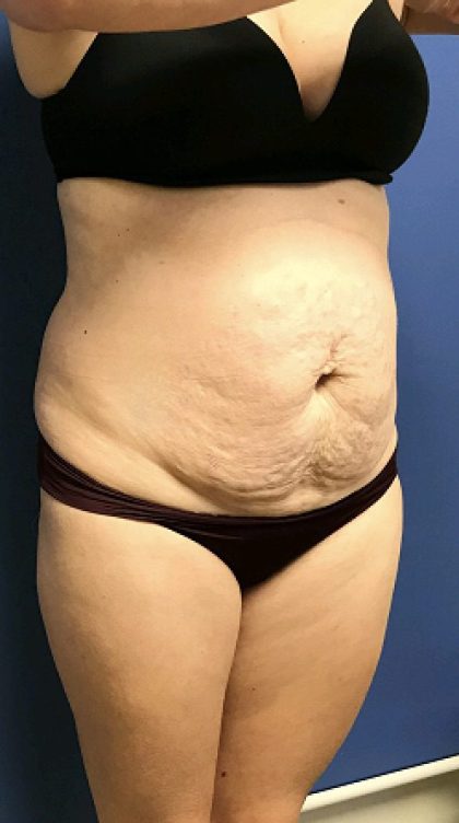 Tummy Tuck Before & After Patient #2532