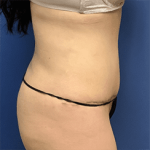 Tummy Tuck Before & After Patient #2539