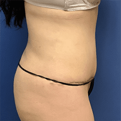 Tummy Tuck Before & After Patient #2539