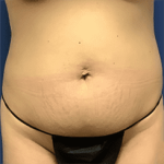 Tummy Tuck Before & After Patient #2539