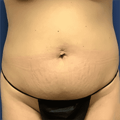 Tummy Tuck Before & After Patient #2539