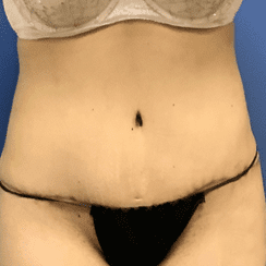 Tummy Tuck Before & After Patient #2539