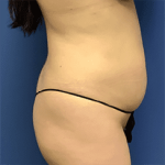 Tummy Tuck Before & After Patient #2539